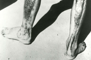 Effect of A-bomb on Human Body in Hiroshima